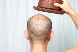 Scalp Micropigmentation NYC - back of bald man head with hat in hand raised above head.