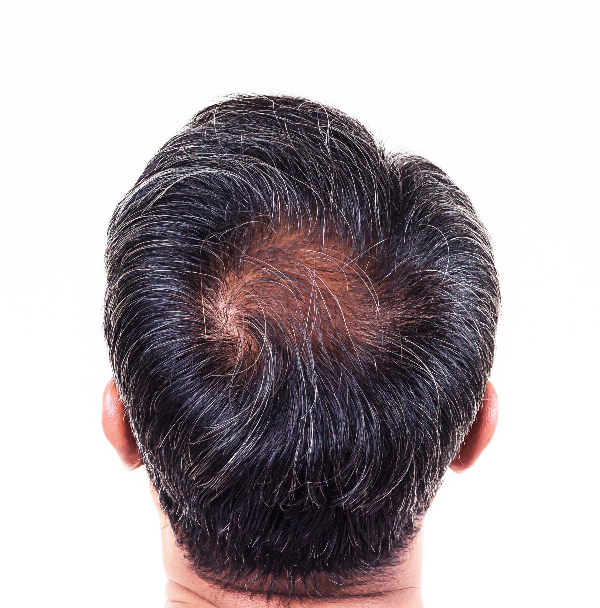 Male Pattern Baldness