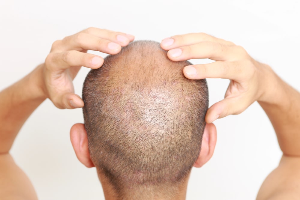 hair transplant procedure